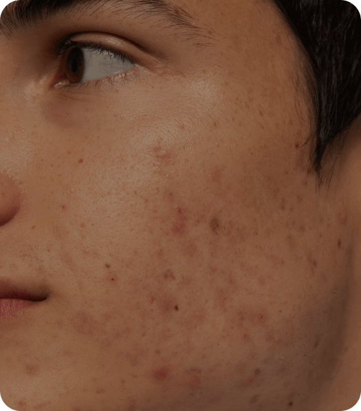 laser treatment