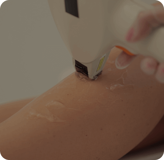 laser treatment