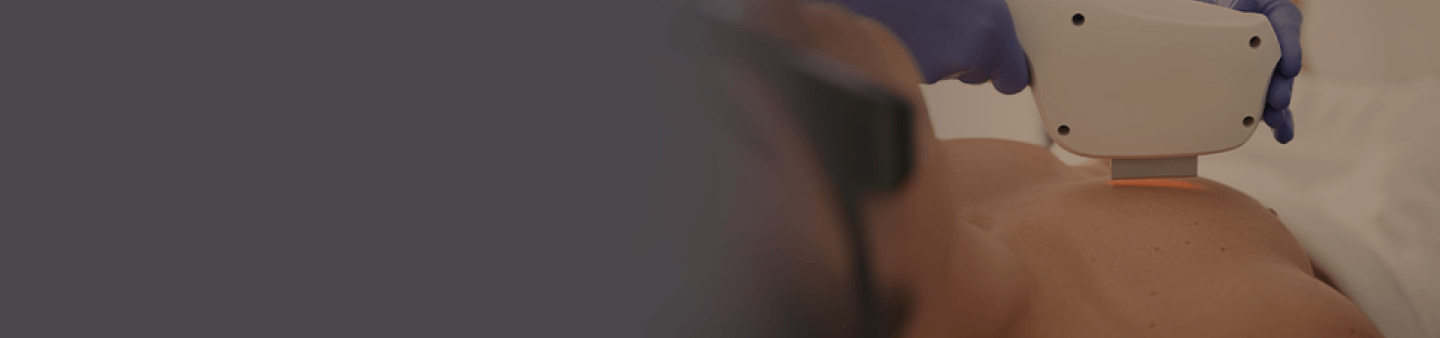 laser treatment